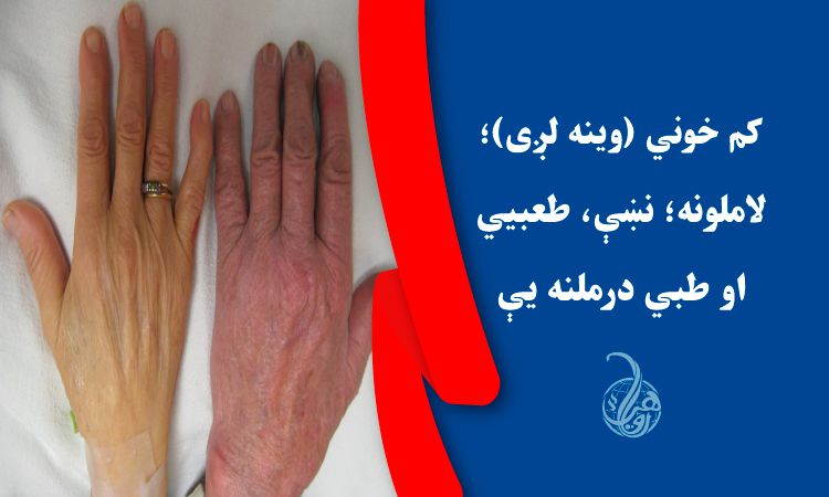 کم خوني (وينه لږی)؛ لاملونه؛ نښې، طعبيي او طبي درملنه يې 